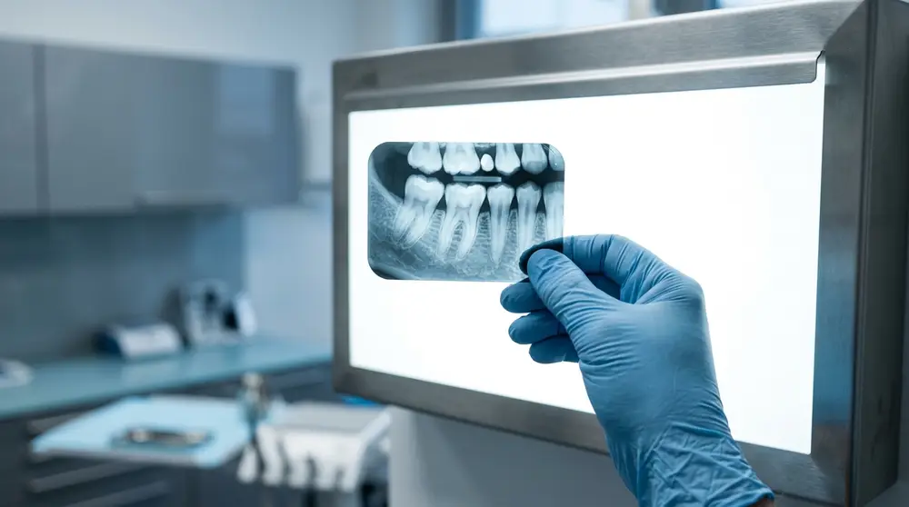 Dental-Röntgenbild auf Leuchtkasten — Diagnose vor einer Wurzelbehandlung